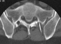 Nadellage an der Lendenwirbelsäule