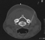 Nadellage CT gesteuert an der Halswirbelsäule