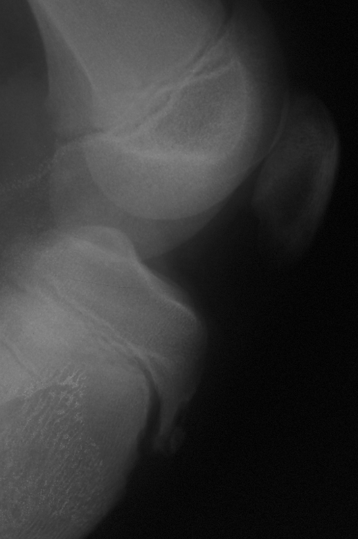 Morbus Osgood Schlatter
